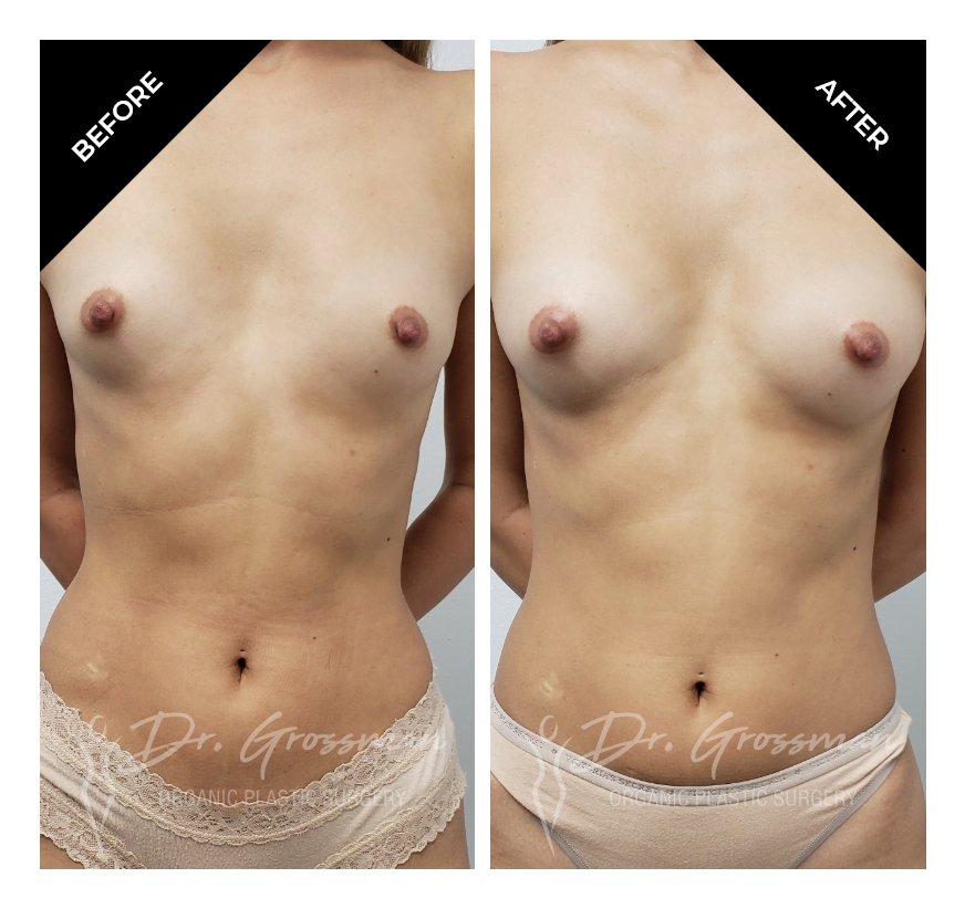 Before and After Skinny breast augmentation with fat | Dr. Leonard Grossman M.D. | New York