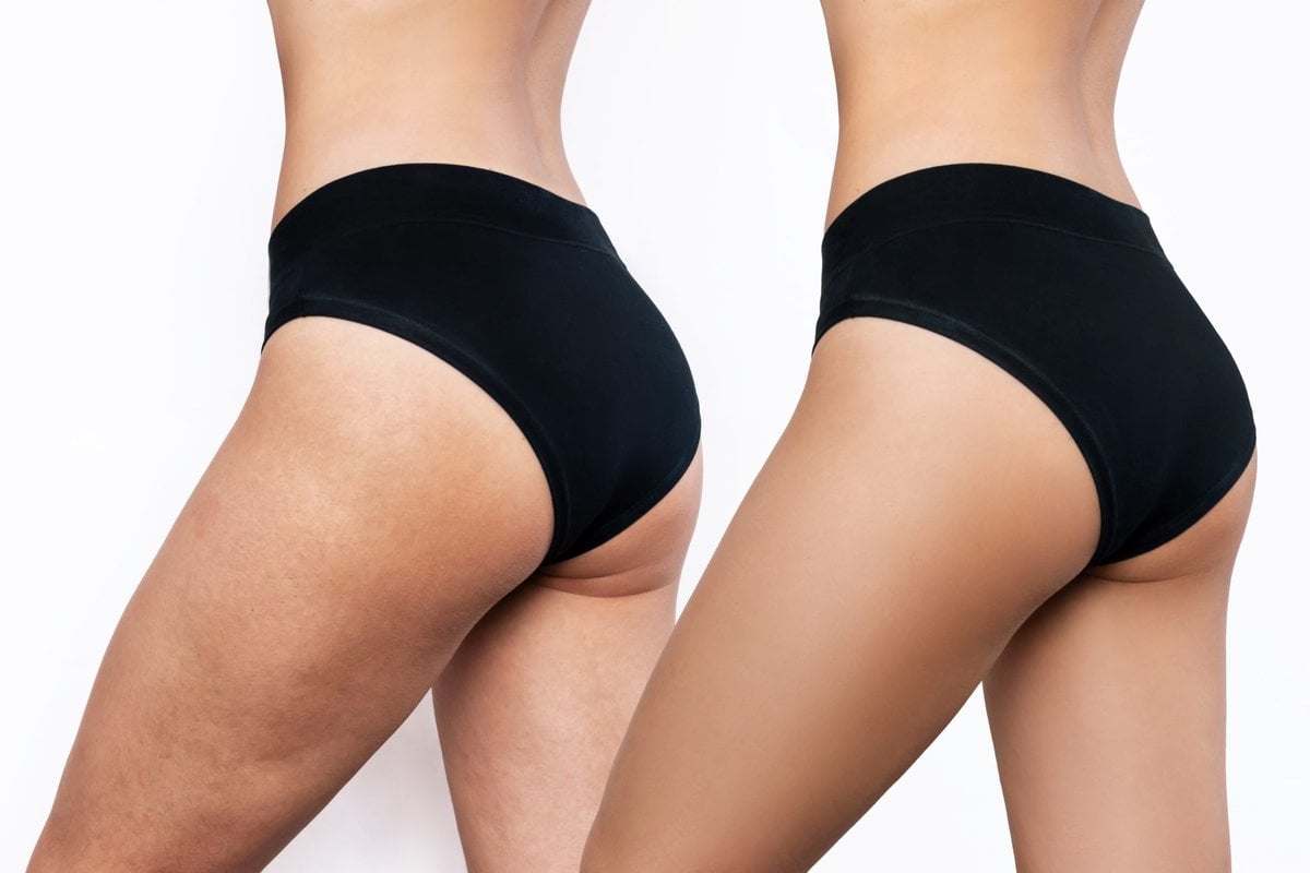 Who Is A Good Candidate For Thigh Lift?