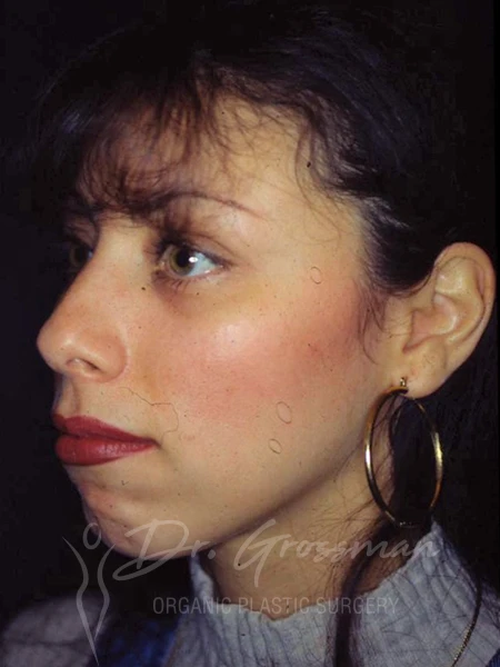drgrossman CHIN AUGMENTATION acc | Portfolio