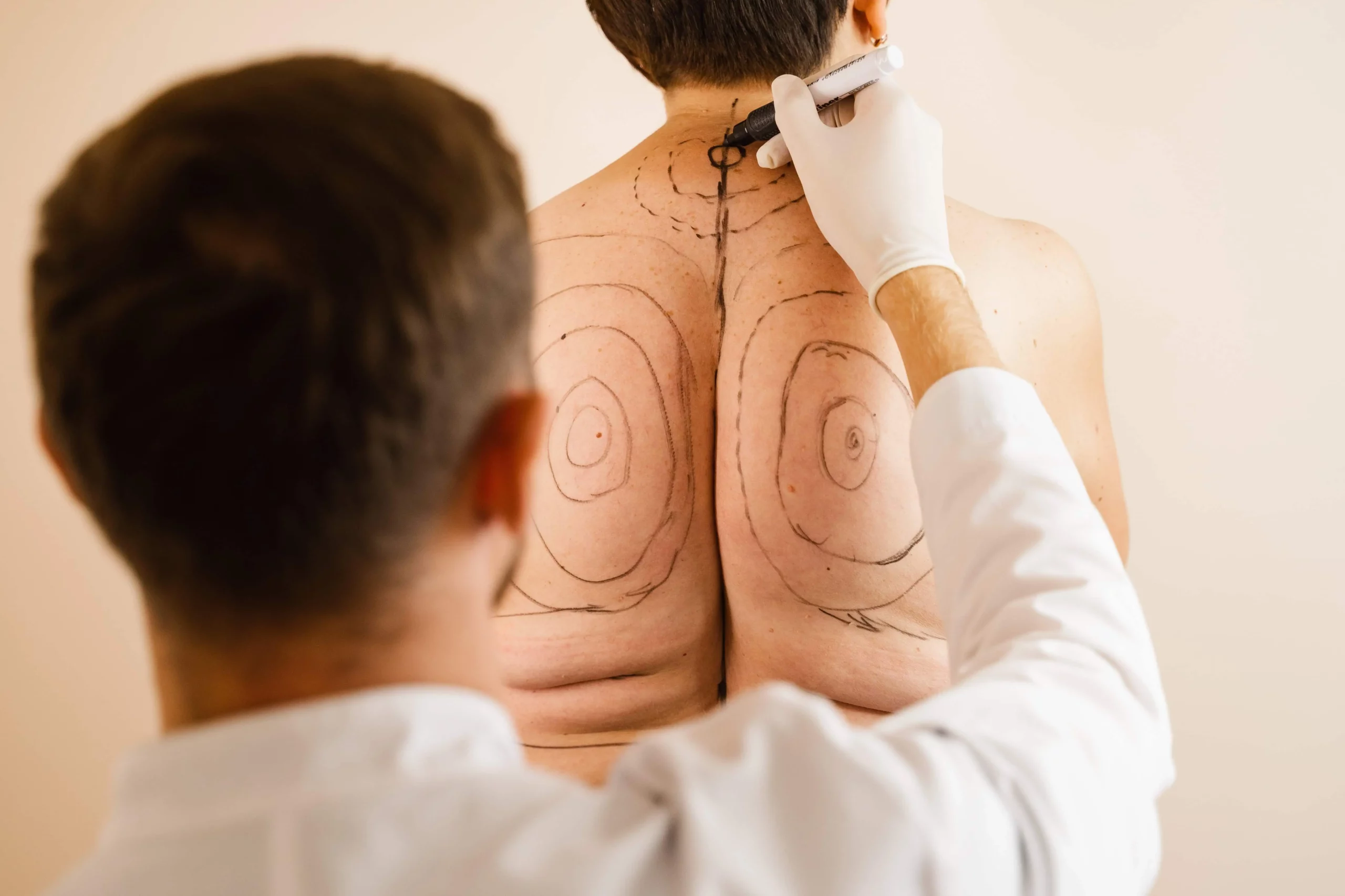 Buffalo Hump Treatment with Liposuction by Dr Grossman in NY US scaled | Portfolio