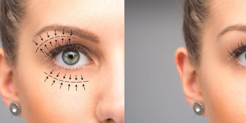Transumbilical Breast Augmentation Benefits 1 Blepharoplasty / Eyelid Lift | Dr. Leonard Grossman M.D. | NY