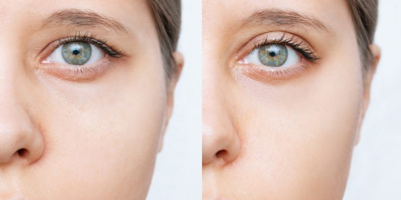 Blepharoplasty / Eyelid Lift | Dr. Leonard Grossman M.D. | NY
