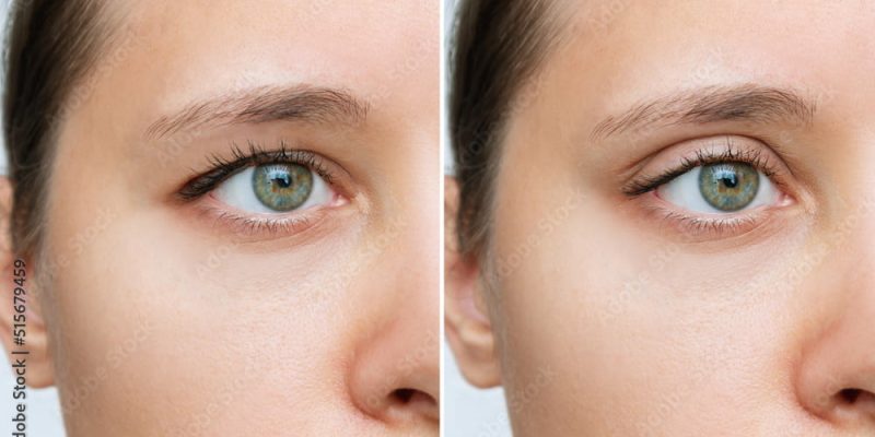 Blepharoplasty / Eyelid Lift | Dr. Leonard Grossman M.D. | NY